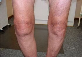 How to treat knee articulation arthrosis