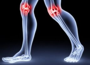 The reasons for the development of knee arthrosis