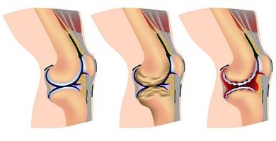 Knee articulation arthrosis development stages