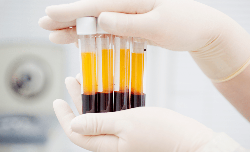 Platelet Rich Plasma for PRP Therapy for Osteoarthritis