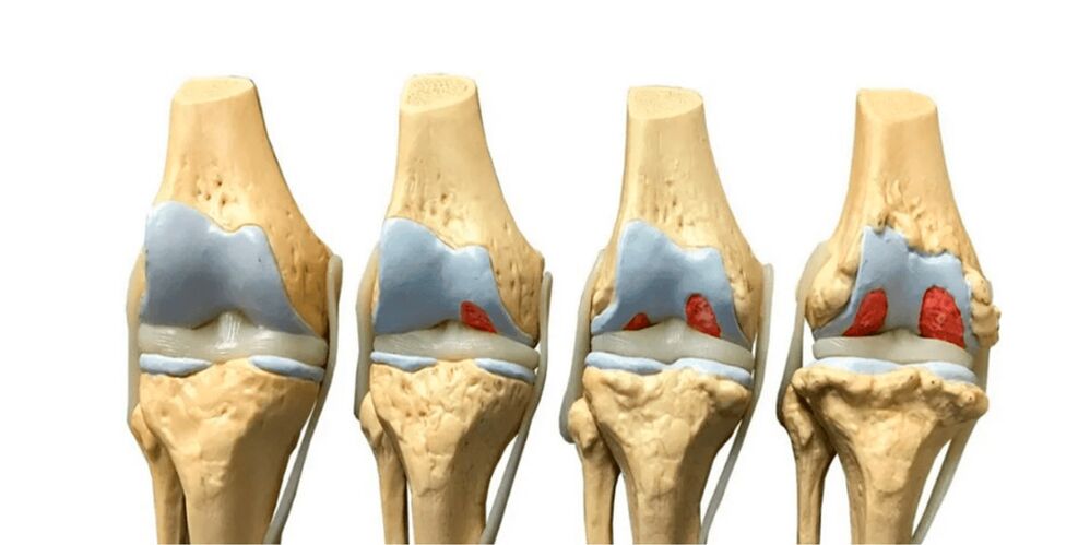 degree of joint arthrosis